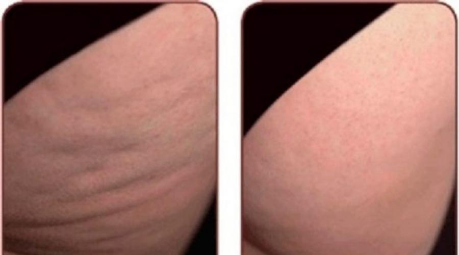 Is it possible to fully cure cellulite. Cellulite: When do you need medication treatment? How does shock-wave therapy
