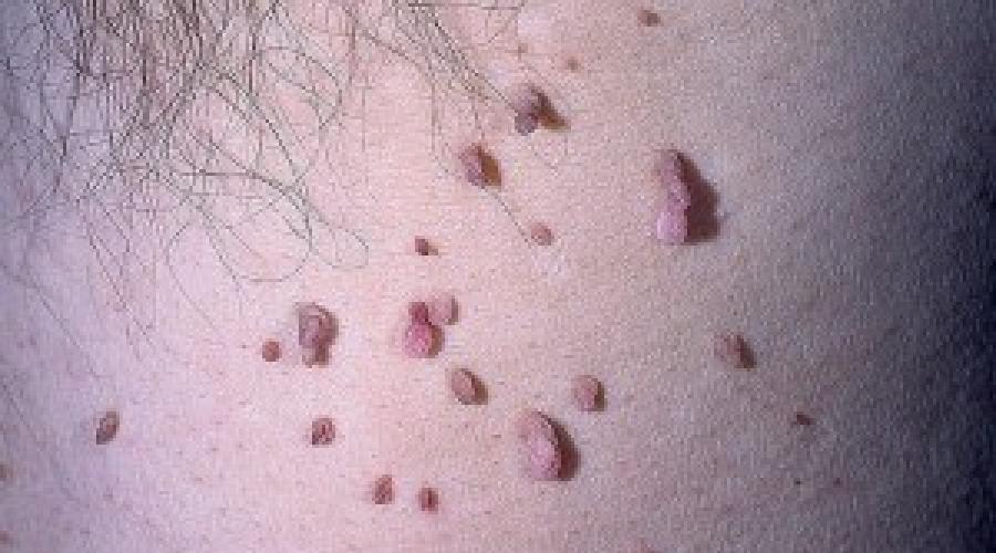 Poreklo papiloma na tijelu.  Mali papilomi na tijelu: opasnost, liječenje i prevencija.  Kako se HPV prenosi?