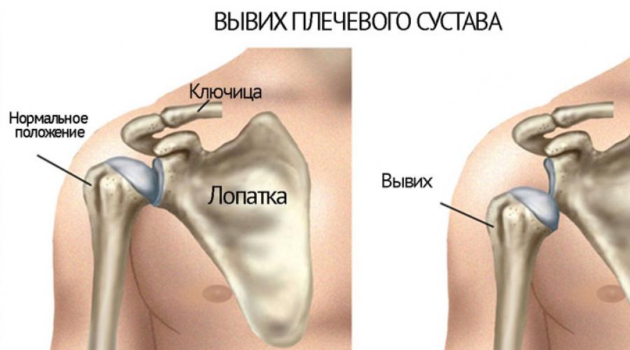 Болит плечо после лечения вывиха. Вывих плечевого сустава: лечение в домашних условиях. Вывих плечевого сустава: причины. Причины и симптомы вывиха плеча