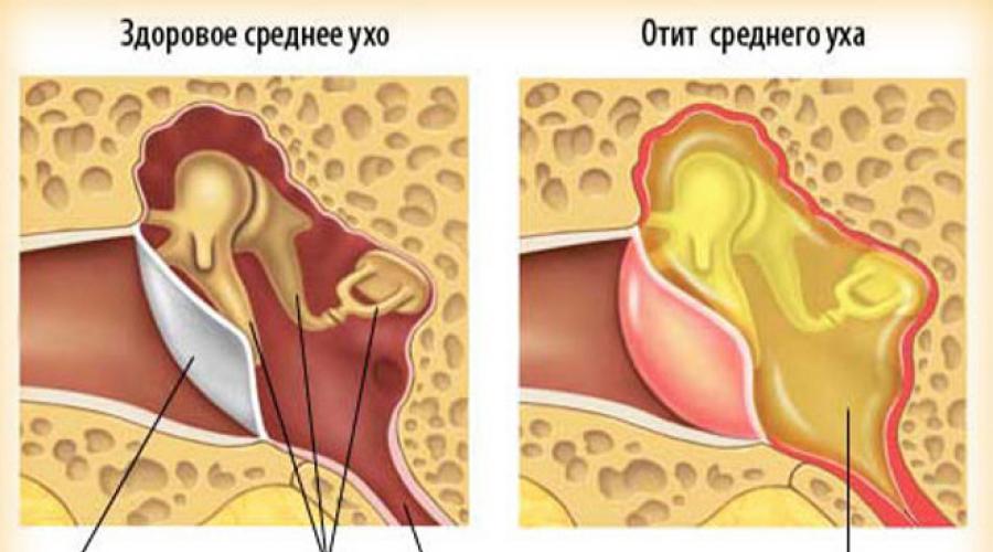 Отит у ребенка картинки