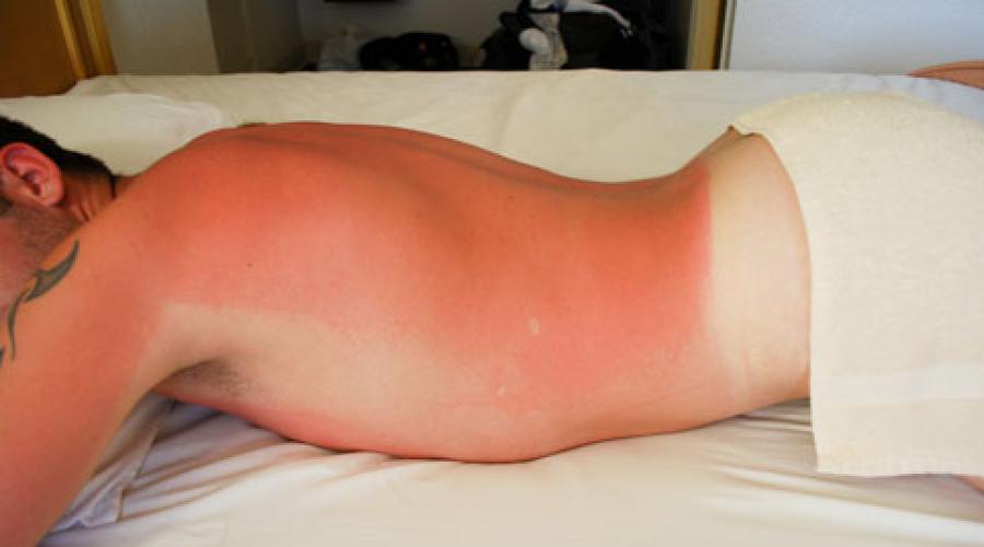 نحوه از بین بردن سوختگی صورت پس از آفتاب.  نحوه درمان آفتاب سوختگی در خانه.  داروهای مردمی برای محافظت از پوست در برابر آفتاب سوختگی و از بین بردن آثار ناخوشایند آن
