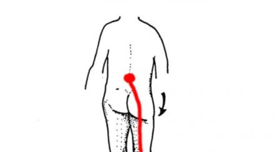 คุณสมบัติของการรวมตัวของอาการของโรค Lumboy รหัสโรค Lumboingsenia รุ่น Vertebrogenic 54.4