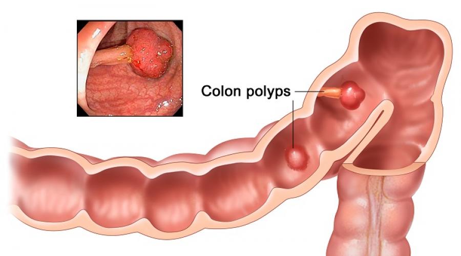 Polipi u simptomima i tretmanu crijeva. Crijevni polipi. Posljedice polipa u crijevima