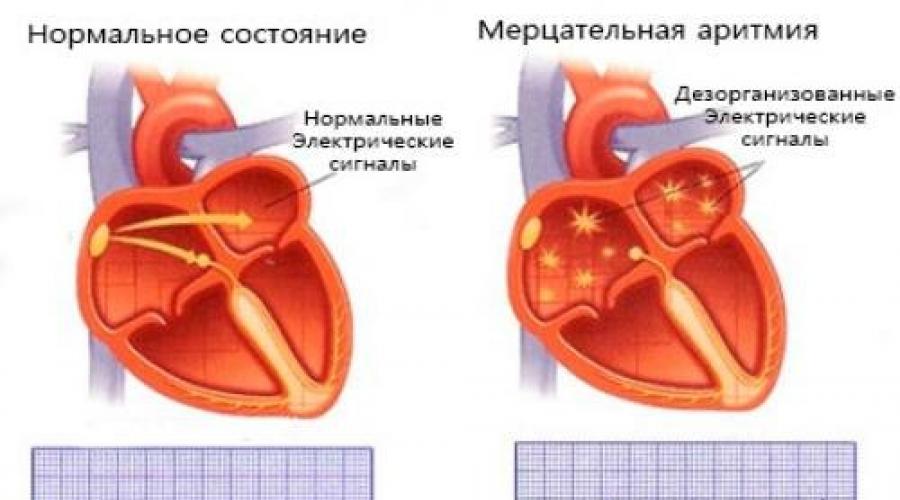 Мерцательная сердце. Сердце в нормальном состоянии. Мерцательная аритмия сердца и митральный клапан сердца. Жизнеугрожающая аритмия сердца. Заболевание мерцающее сердце.